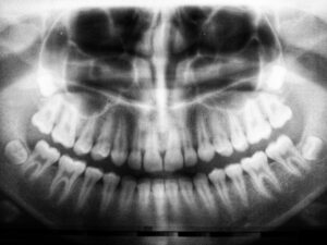 Patient receiving dental X-rays in Shepperton for diagnostic clarity